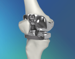 Vue intérieur d'un genou après une chirurgie de remplacement